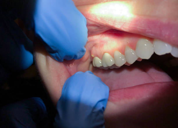 Best Emergency Dental Care for Abscessed Tooth in Frazer, PA